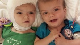 Image for news article Formerly Conjoined Twins Admitted to Blythedale