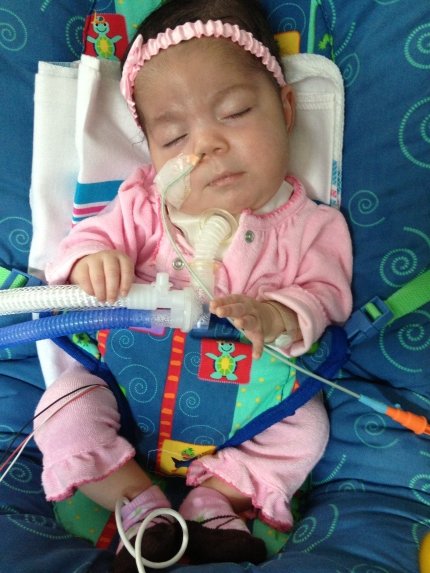 baby with NG tube and tracheostomy